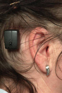 Cochlear-Implantat