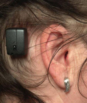 Cochlear-Implantat